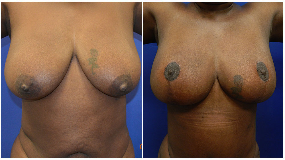 Breast Augmentation with Lift